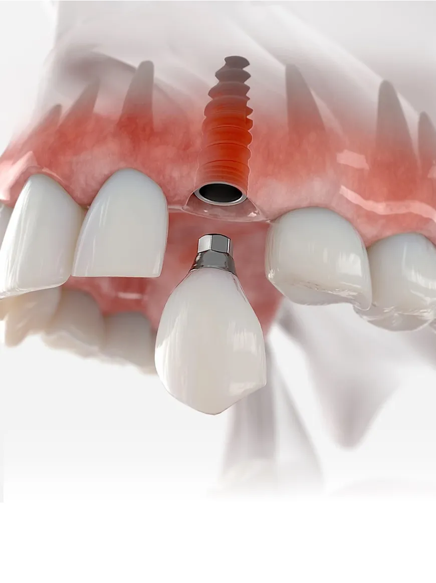 Trồng răng implant thay thế 1 răng